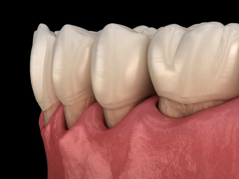 can-gum-recession-be-reversed-at-home-hoffman-dental-care