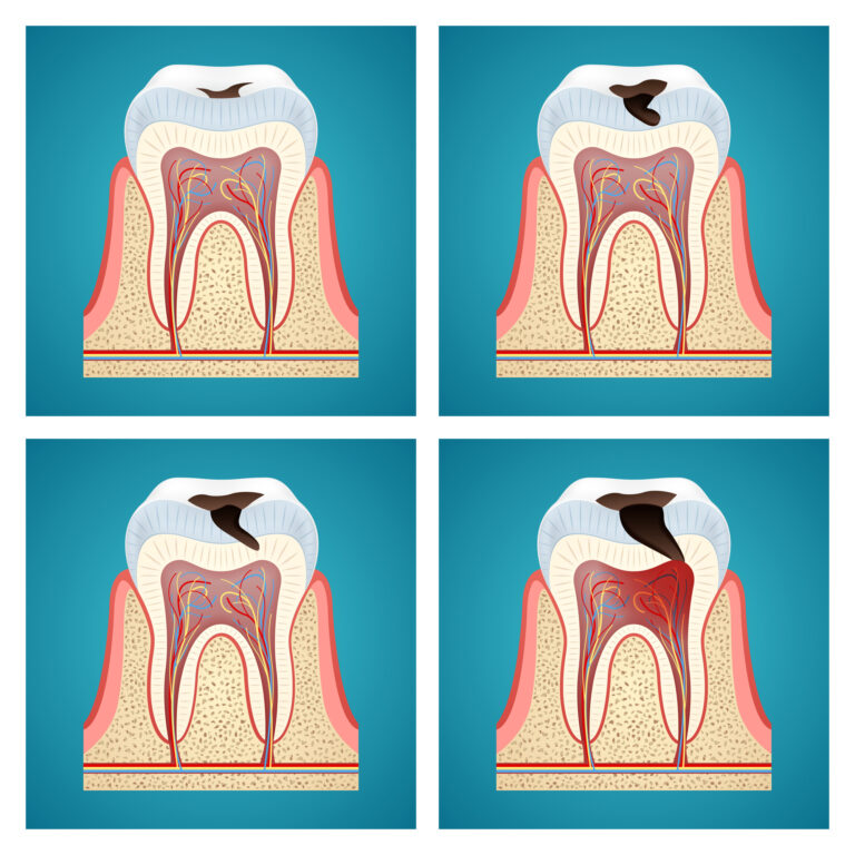 southport-dental-10-facts-you-should-know-about-tooth-decay